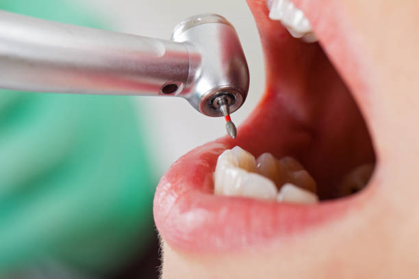 Best Emergency Dental Care for Broken or Chipped Teeth in Blowing Rock, NC